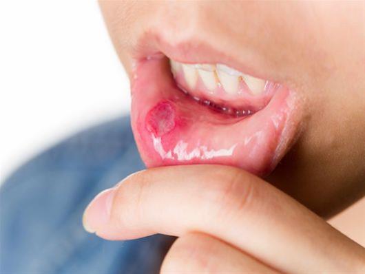 Καρκίνος του στόματος: Ποια τα συμπτώματα – Ποιοι οι παράγοντες κινδύνου
