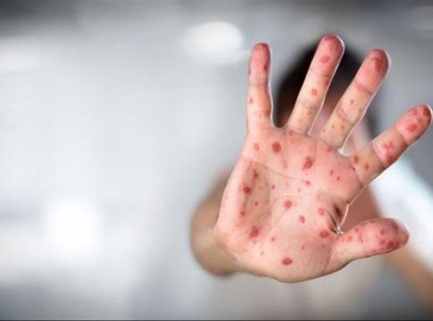 Οι διευκρινίσεις του ΕΟΔΥ για την επιδημία ιλαράς στη χώρα μας