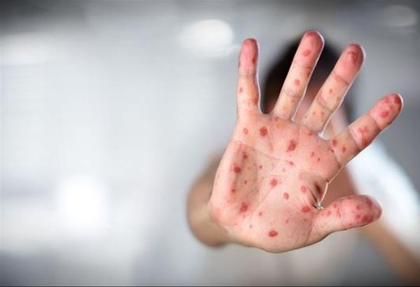 Οι διευκρινίσεις του ΕΟΔΥ για την επιδημία ιλαράς στη χώρα μας
