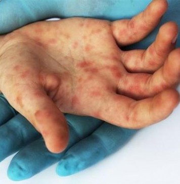 Εθνική Επιτροπή Εμβολιασμών: Δεν υπάρχει επιδημία ιλαράς στην Ελλάδα