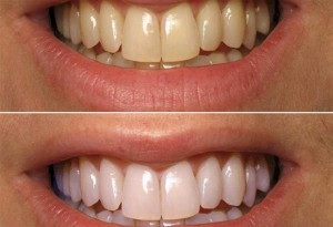 Κίτρινα δόντια: Αντιμετώπιση με 11 έξυπνες και απλές λύσεις