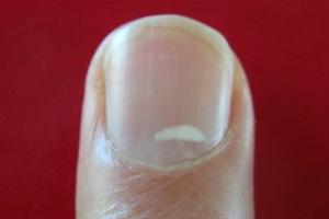 Μύθος ότι οι λευκές κηλίδες στα νύχια δείχνουν έλλειψη ασβεστίου