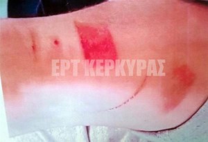 Σπουδαστής μαγειρικής καταγγέλλει βασανιστήρια με καυτό λάδι σε εστιατόριο της Κέρκυρας