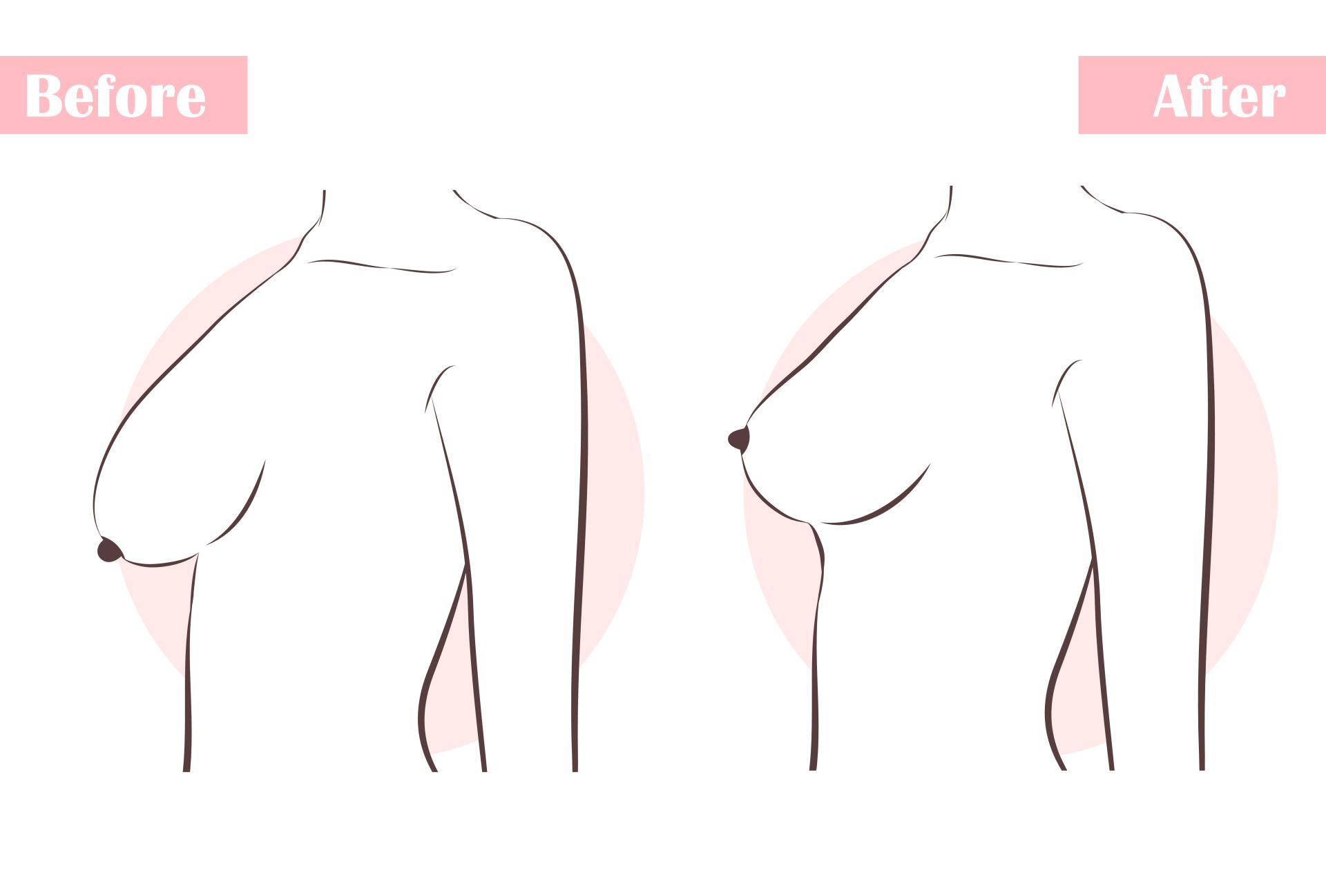 Ανόρθωση στήθους πριν και μετά
