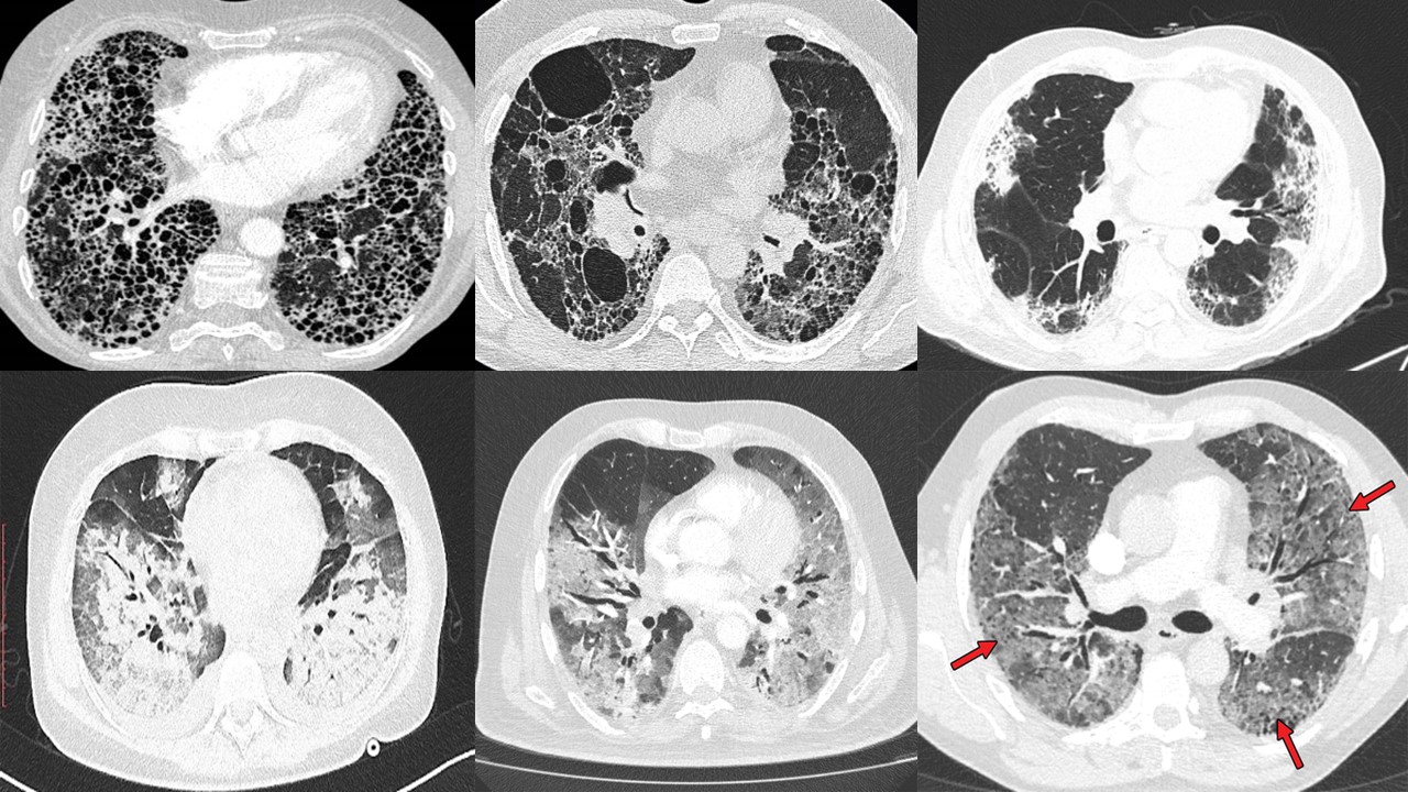 Εικόνες από αξονικές με ασθενείς με διάμεση πνευμονοπάθεια